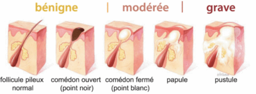 solution d'argent colloidal contre les boutons